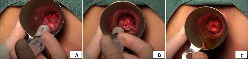 Polidocanol foam injection sclerotherapy in patients with mixed hemorrhoids with severe anemia: a case report.