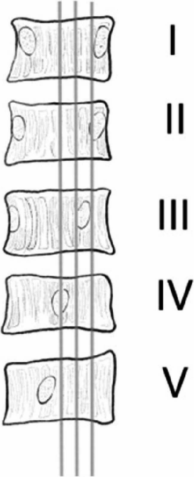 Preoperative coronal imbalance in degenerative scoliosis: a study on coronal and sagittal spinal-pelvic parameters--a retrospective study.
