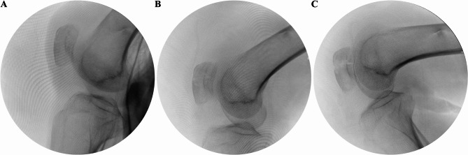 A novel approach to the minimally invasive application of a tension band for transverse patellar fractures assisted by a nice knot.