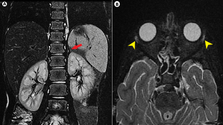 Double 'A' phenotypes with mineralocorticoid deficiency: A rare presentation of Allgrove syndrome.