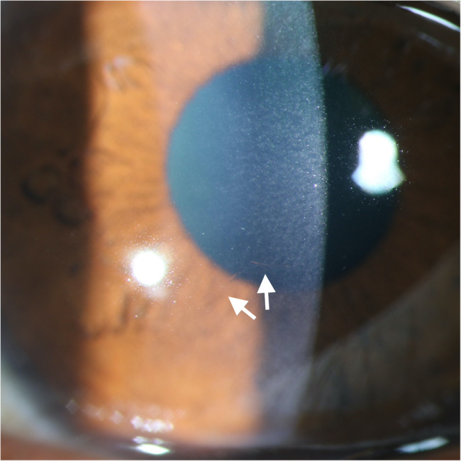 The ocular frostbite involving cornea caused by low-temperature environment.