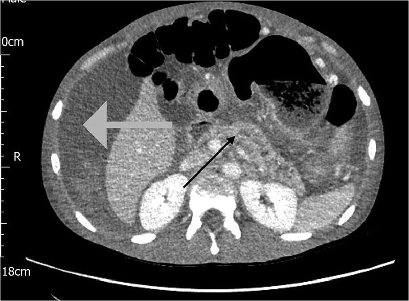 Unseen crisis: the unexpected face of acute haemorrhagic pancreatitis.