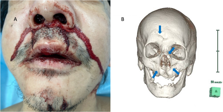 Genital burns caused by cell phone combustion following a motorcycle accident: a case report.