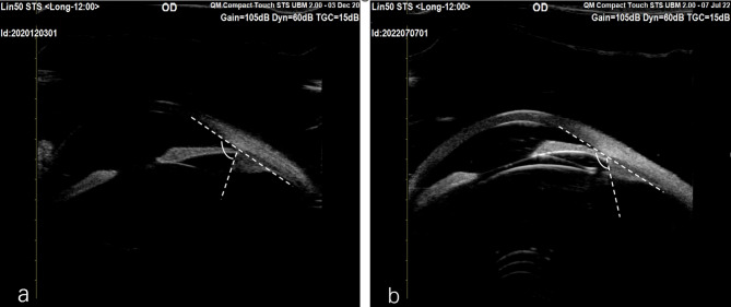 Recurrent 0 μm vault complicated with anterior subcapsular cataract after toric ICL in an eye with multiple anatomical risk factors: clinical reflections.