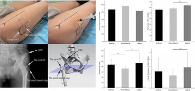 Comparison of the Clinical Efficacy of the Anterolateral and Regular Approaches for Hip Joint Puncture: A Randomized Cross-Over Trial.