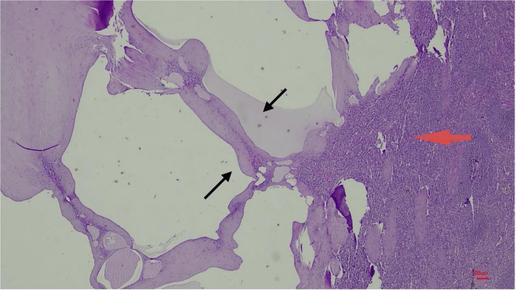 An Uncommon Confluence: Splenic Lymphangioma and Appendiceal Mucinous Neoplasm.