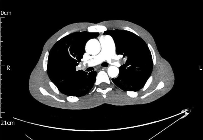 Unseen crisis: the unexpected face of acute haemorrhagic pancreatitis.