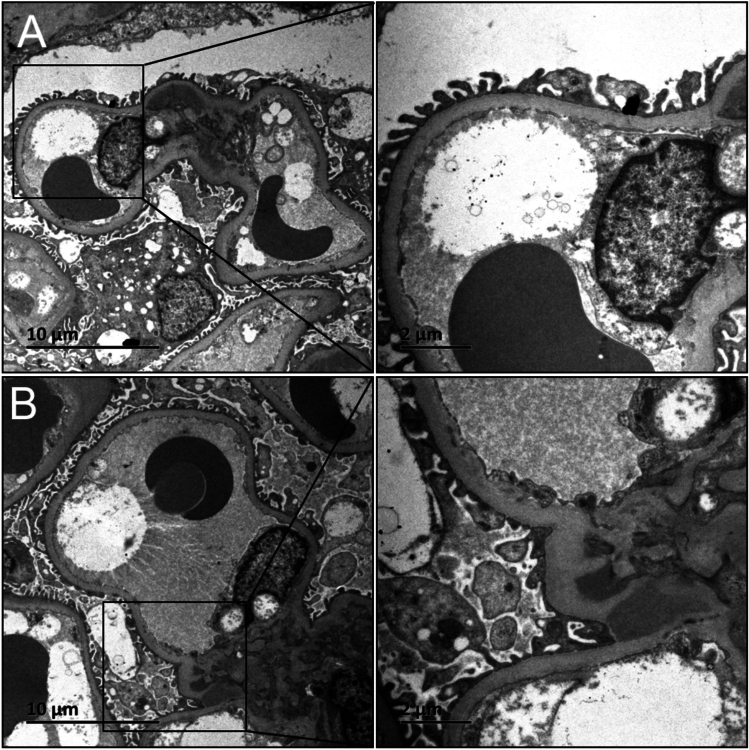 The importance of the degree of foot process effacement in evaluating the prognosis of IgA nephropathy.