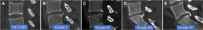 Sagittal Classification of Calcified Lumbar Disc Herniation and Therapeutic Analysis of Percutaneous Endoscopic Interlaminar Discectomy.
