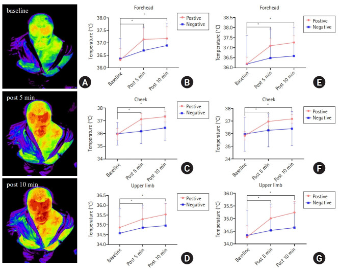 The 90% minimum effective volume and concentration of lidocaine for ultrasound-guided stellate ganglion blocks in adults: a biased-coin design, up-and-down sequential allocation trial.