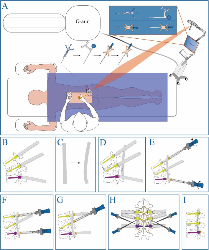 Clinical efficacy and radiological outcomes of a novel screw placement technique for the treatment of traumatic thoracolumbar vertebral fractures under navigation guidance.