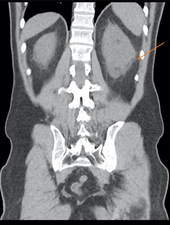 An Interesting Case of Fornix Rupture Discovered Accidentally on Bone Scintigraphy.