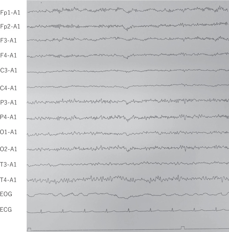 Successful treatment of five cases of catatonia treated with guanfacine without ECT: a case series from a psychiatric hospital in Japan.