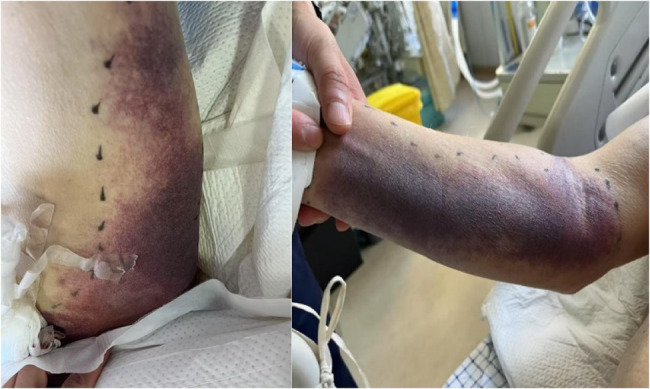 Successful management with hemoperfusion and antidotal therapy of severe combined dichlorvos and rodenticide poisoning: a case report.