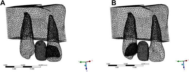 Evaluation of biomechanical behavior of all-ceramic cantilever resin-bonded fixed dental prostheses: a finite element analysis.