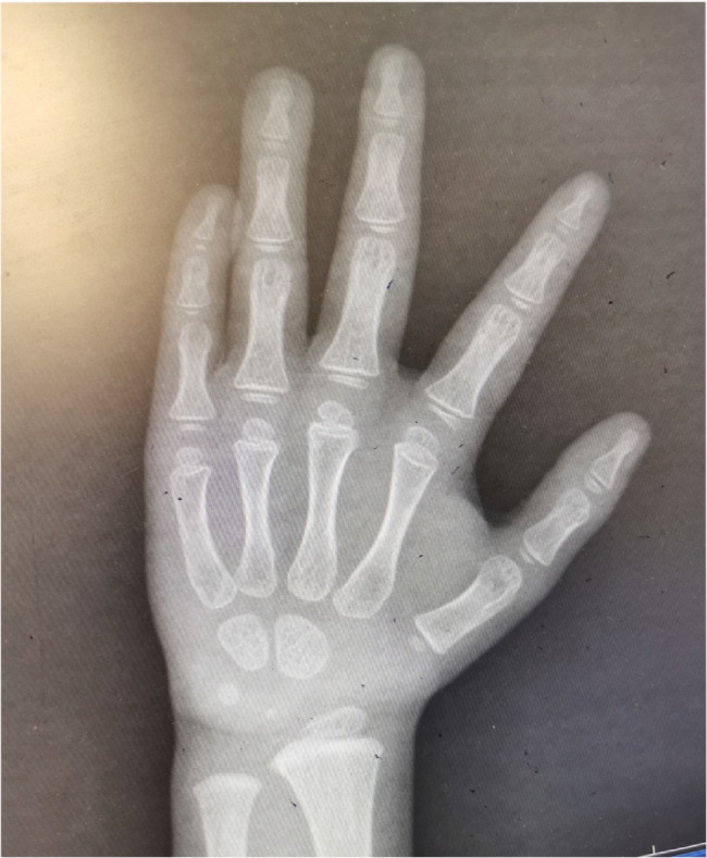 Treatment of a case with short stature and Goltz syndrome with long-acting growth hormone: a case report and follow-up.