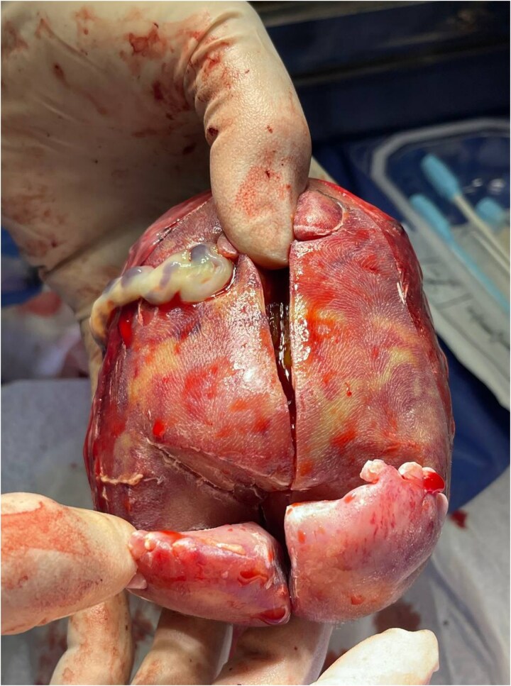 Fetus-in-fetu in an 11-day-old female infant with descriptive histopathological insights: a case report.