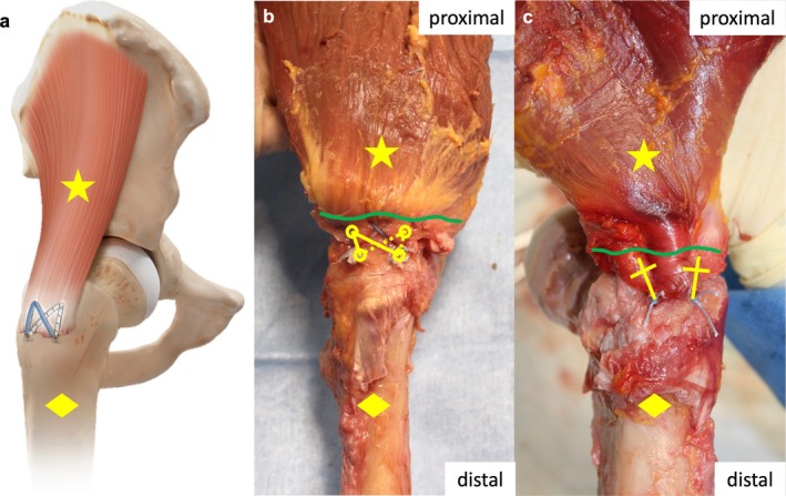Superior Primary Stability of a Knotless Double-Row Construct Compared to Mason-Allen Repair for Anatomical Refixation of Gluteal Tendons-Biomechanical Human Cadaver Study.