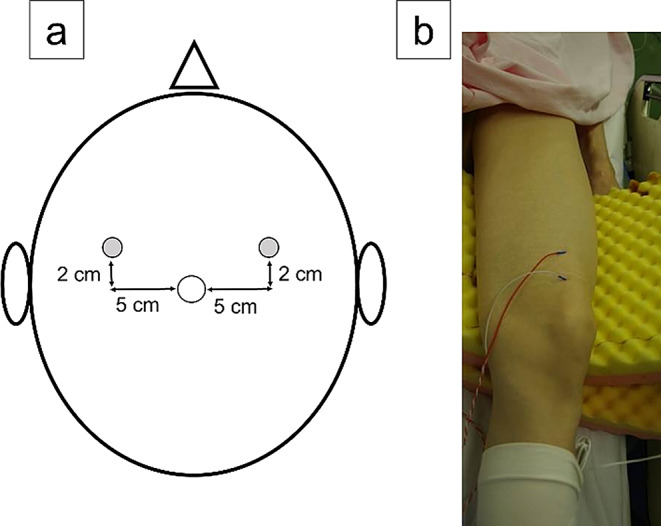 Comparison of quadricep motor evoked potentials between different surgical positions during total hip arthroplasty.