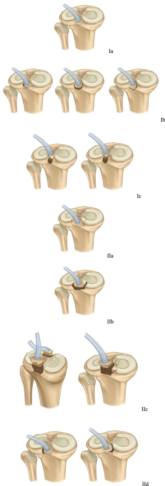 A new CT-based classification system for posterior cruciate ligament tibial avulsion fractures: a nationwide multicenter study.