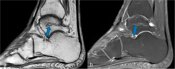 Talus insufficiency fracture due to long-term methotrexate therapy in a patient with rheumatoid arthritis.