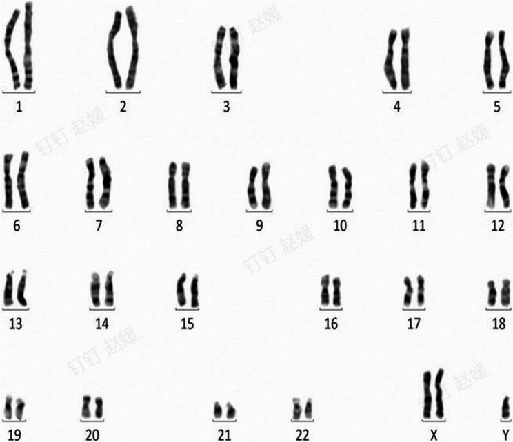 A case of spherophakia-induced angle closure and retinal dysfunction in association with Klinefelter syndrome.
