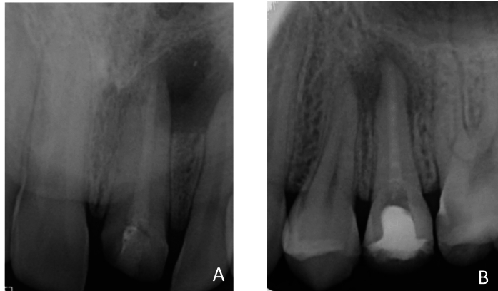 Effect of tricalcium silicate-based intracanal dressing on bone resorption and inflammatory mediators in periapical lesions: a randomized controlled clinical trial.