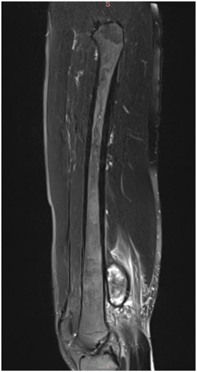 Pseudoaneurysm of the Superficial Femoral Artery Secondary to Exostosis-like Lesion Trauma After Hamstring Tear: A Case Report.