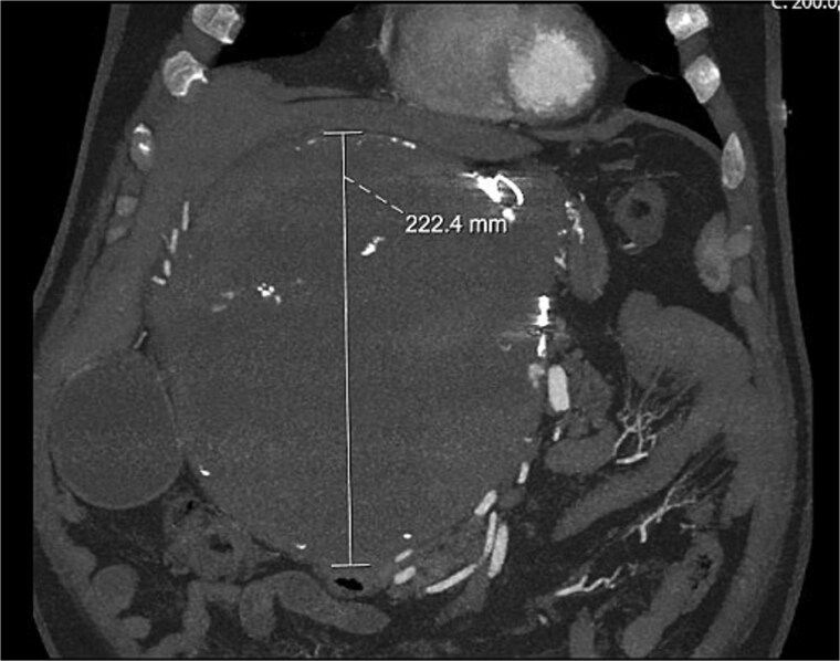 Open repair of a giant hepatic artery aneurysm.