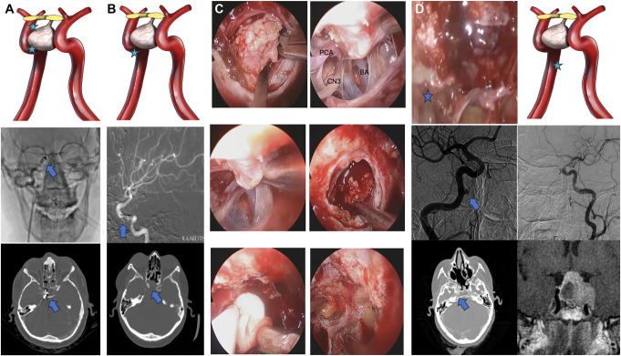 Management of Major Arterial Injuries: A Critical Complication of Endoscopic Endonasal Surgery.