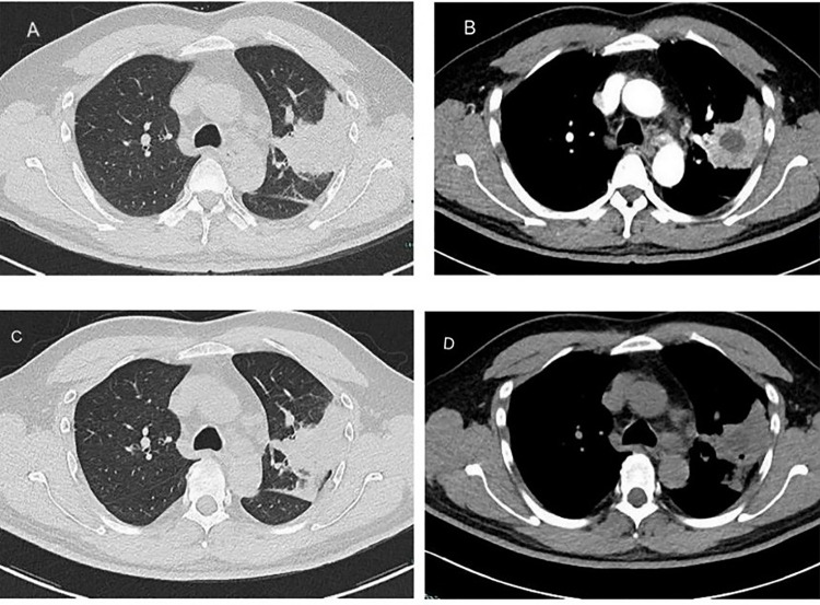 Metagenomic Next-Generation Sequencing Reveals <i>Tannerella forsythia</i> in Lung Abscesses: A Retrospective Case Series Linking Smoking, Oral Health, and Diagnostic Challenges.