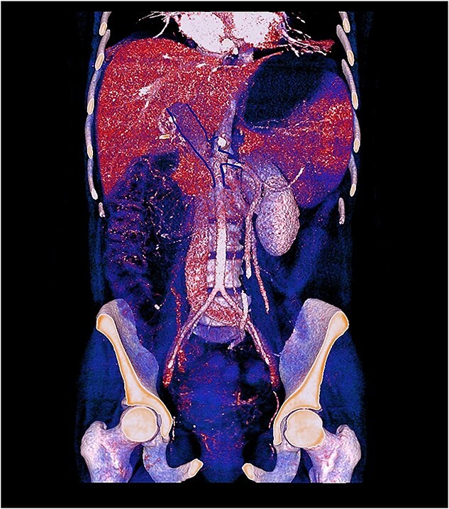 Porto-spleno-mesenteric thrombosis secondary to medroxyprogesterone acetate as a treatment for abnormal uterine bleeding: a case report.