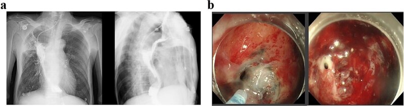 Late-onset esophagogastric anastomotic fistula managed without continuous fasting: a case report.