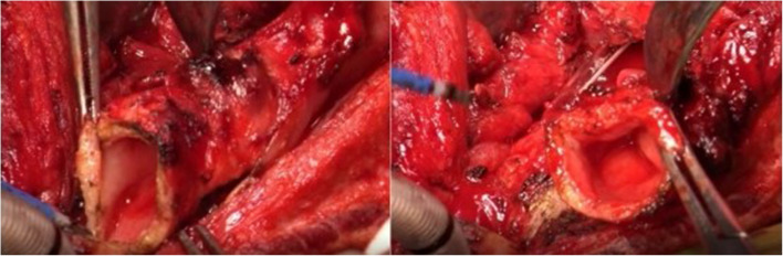 Significance of the use of a laryngotracheal flap to reconstruct defects and manage pharyngoesophageal stenosis after the resection of hypopharyngeal carcinoma with cervical oesophagus involvement: a retrospective study.