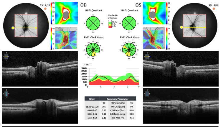 The Role of Exenatide, a Glucagon-Like Peptide-1 (GLP-1) Receptor Agonist, in Idiopathic Intracranial Hypertension and Polycystic Ovary Syndrome: A Case Report.
