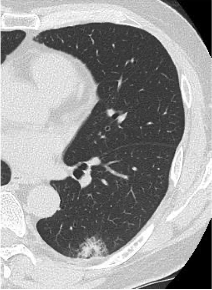 Delayed-onset organizing pneumonia following perioperative COVID-19 after lobectomy.