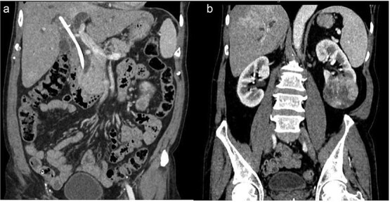 Case report of left renal cell carcinoma with long standing retained common bile duct stent and secondary choledocholithiasis: a single-stage multidisciplinary surgical management in low resource setting.