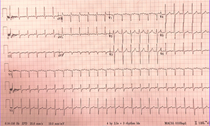 Serial electrical cardioversion for refractory atrial fibrillation with rapid ventricular response post ablation.