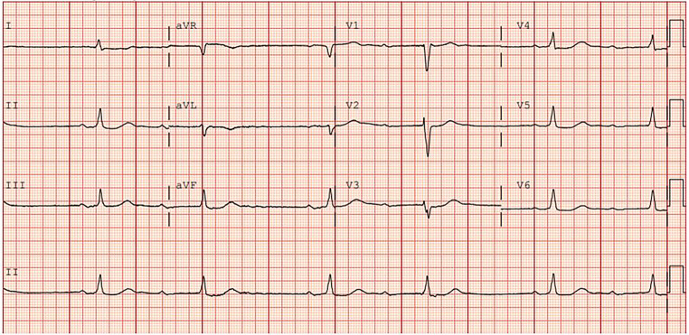 Peculiar conduction.