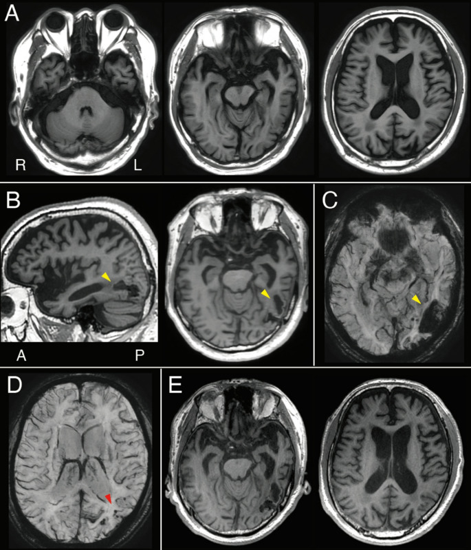 Left inferior temporal hemorrhage due to cerebral amyloid angiopathy mimicking semantic dementia.