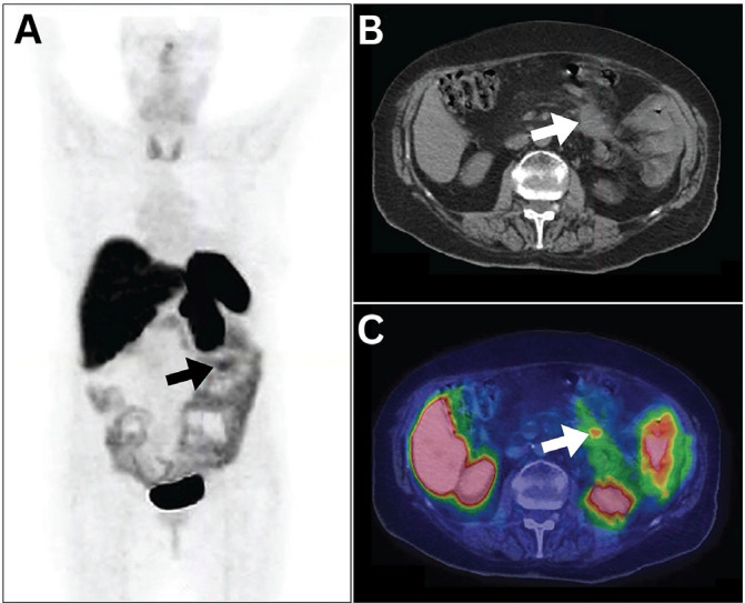 False Positive Findings of <sup>68</sup>Ga-DOTATOC PET/CT: A Systematic Review.