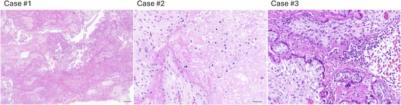 SARS-CoV-2 delta and omicron variants alter trophoblast cell fusion and syncytiotrophoblast dynamics: new insights into placental vulnerability.