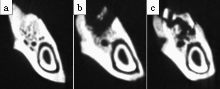 Prevention of bisphosphonate-related osteonecrosis of the jaw with basic fibroblast growth factor: an experimental study in rats.