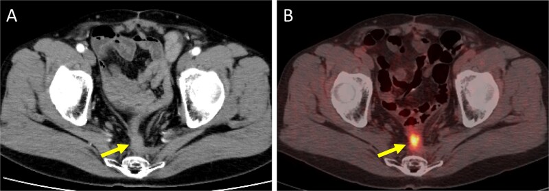 Prophylactic intestinal resection following carbon-ion radiotherapy for locally recurrent rectal cancer: a case report.