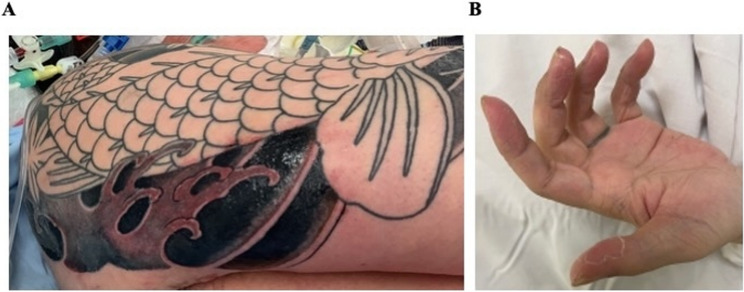 Tattoo-associated toxic shock syndrome: a case report.