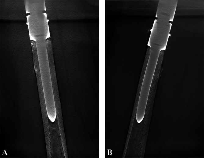 The Survival Rate and Its Influencing Factors of Modular Endoprosthetic Replacement With Uncemented Stem for the Proximal Femur After Primary Tumor Resection.