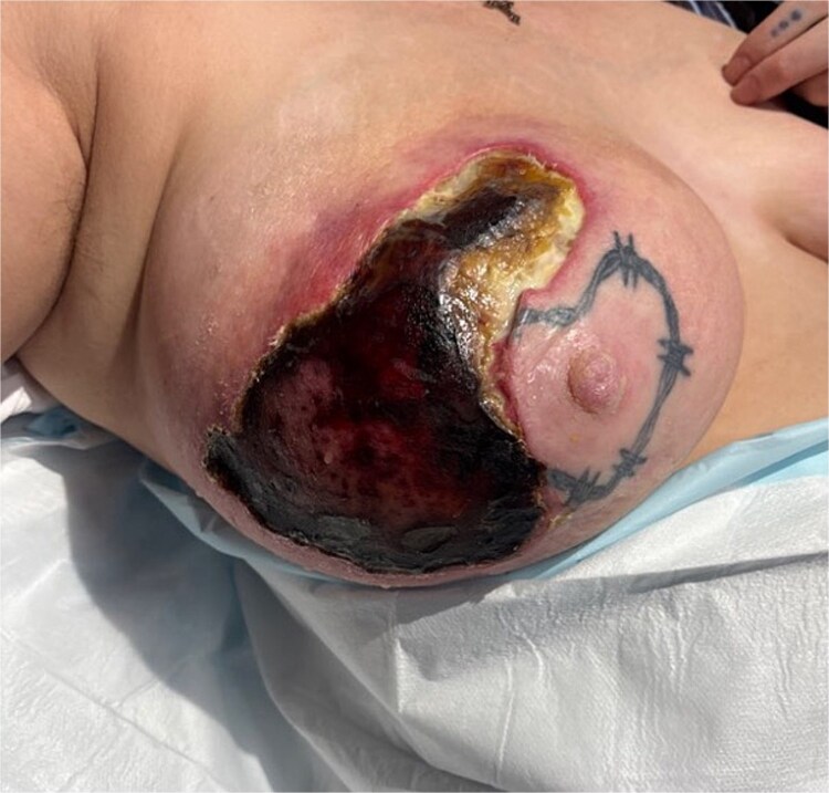 A rare case of necrotic erysipelas of the breast in a healthy, postpartum female.