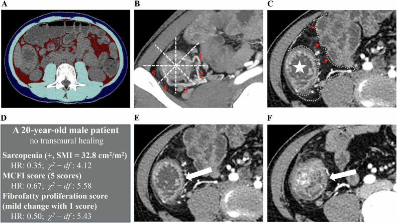 Creeping fat is associated with transmural healing in patients with Crohn's disease receiving ustekinumab.