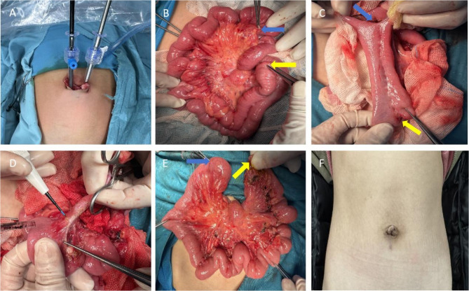 Laparoscopic-assisted resection of long-segment small bowel duplication: a rare case report and review of literature.