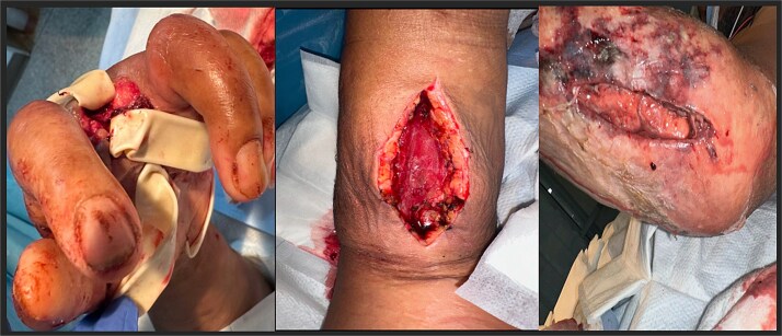 Monomicrobial necrotizing soft tissue infection of upper extremity caused by <i>Eggerthia catenaformis</i>.